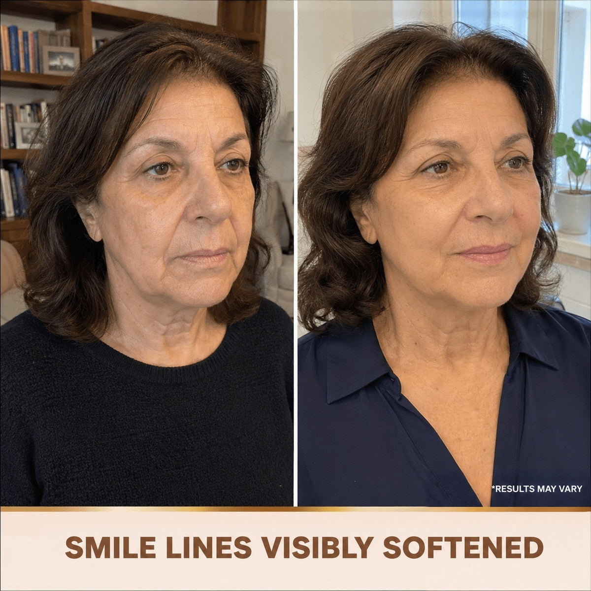Smile lines softened