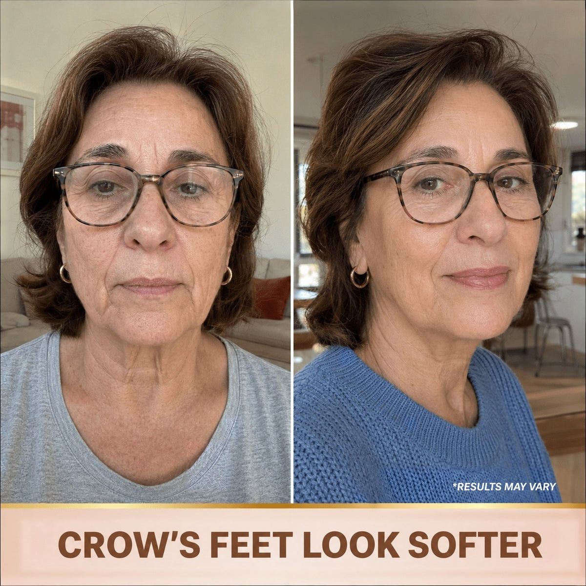 Crow's feet reduced