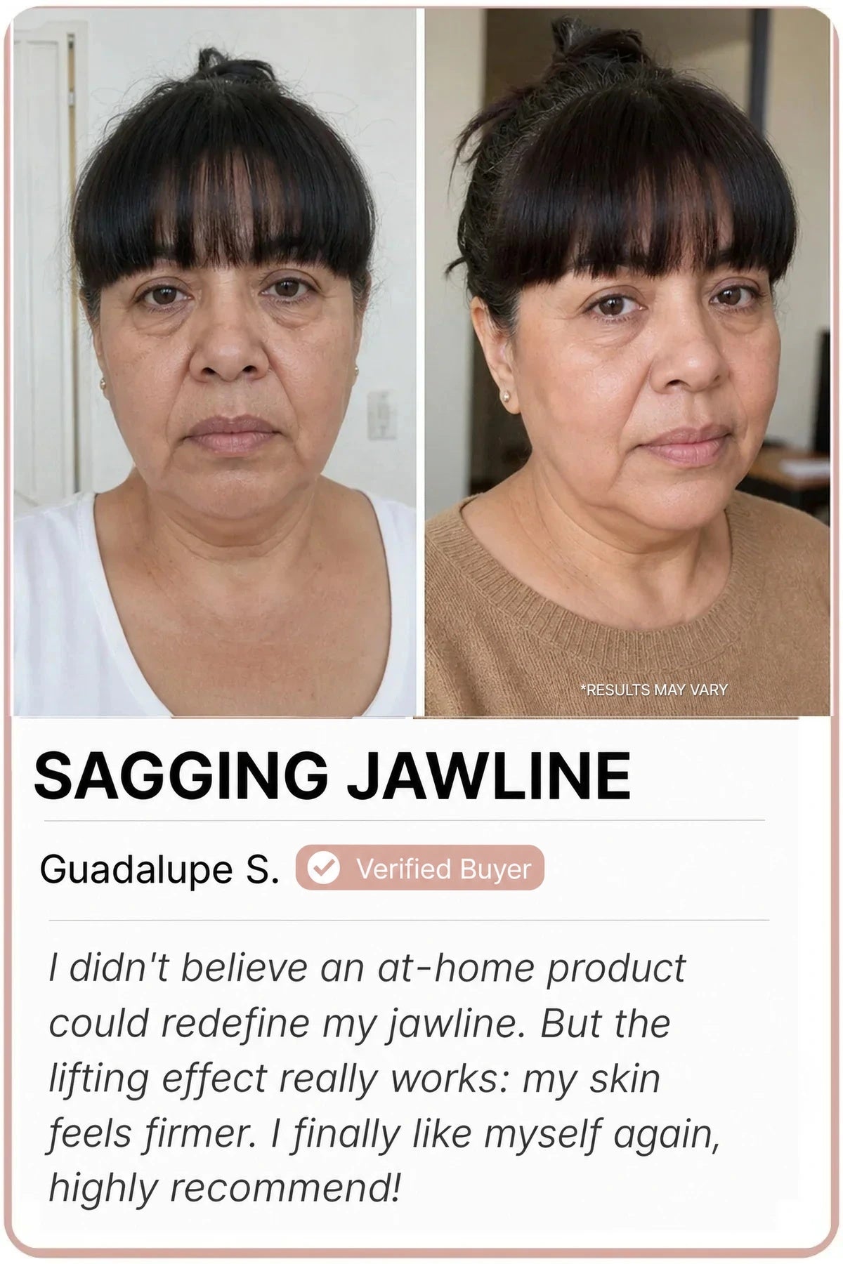 Sedanza before and after — Sagging jawline, Guadalupe S.