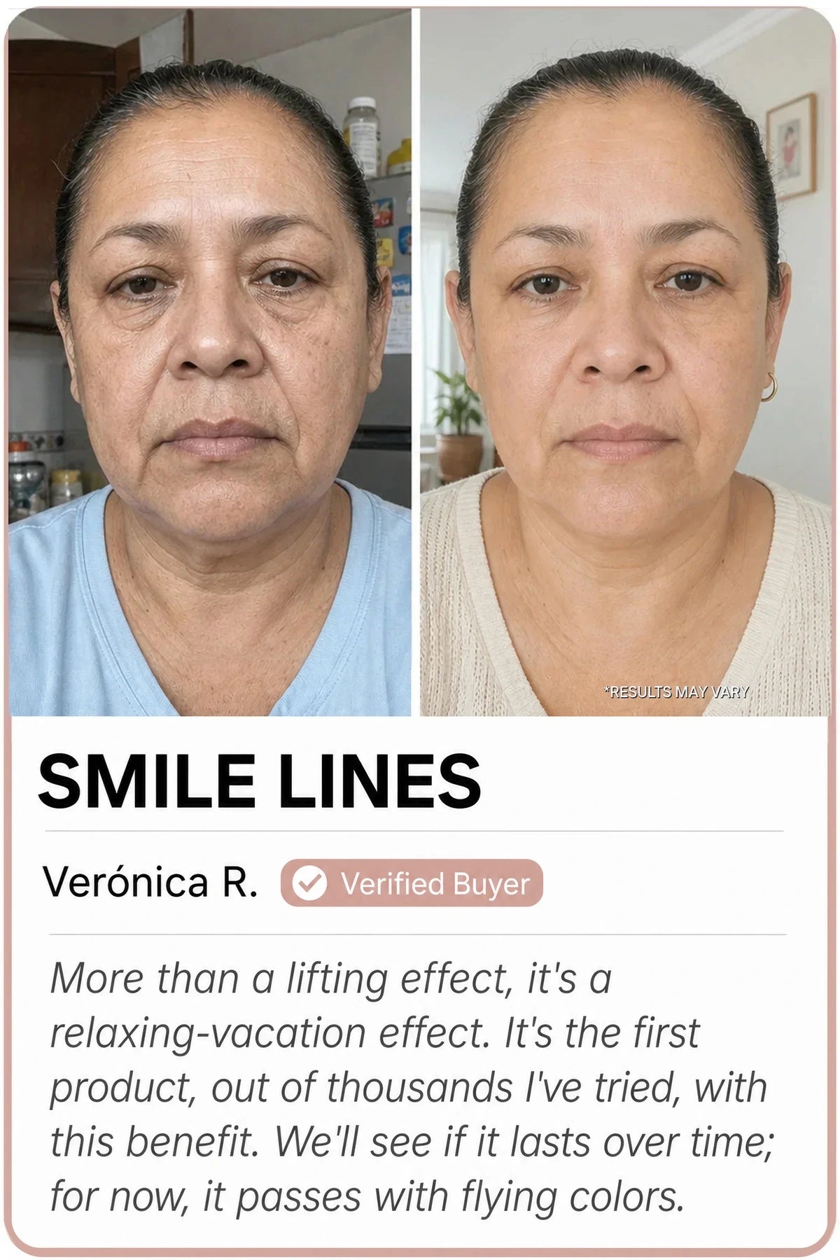 Sedanza before and after — Nasolabial folds, Verónica R.