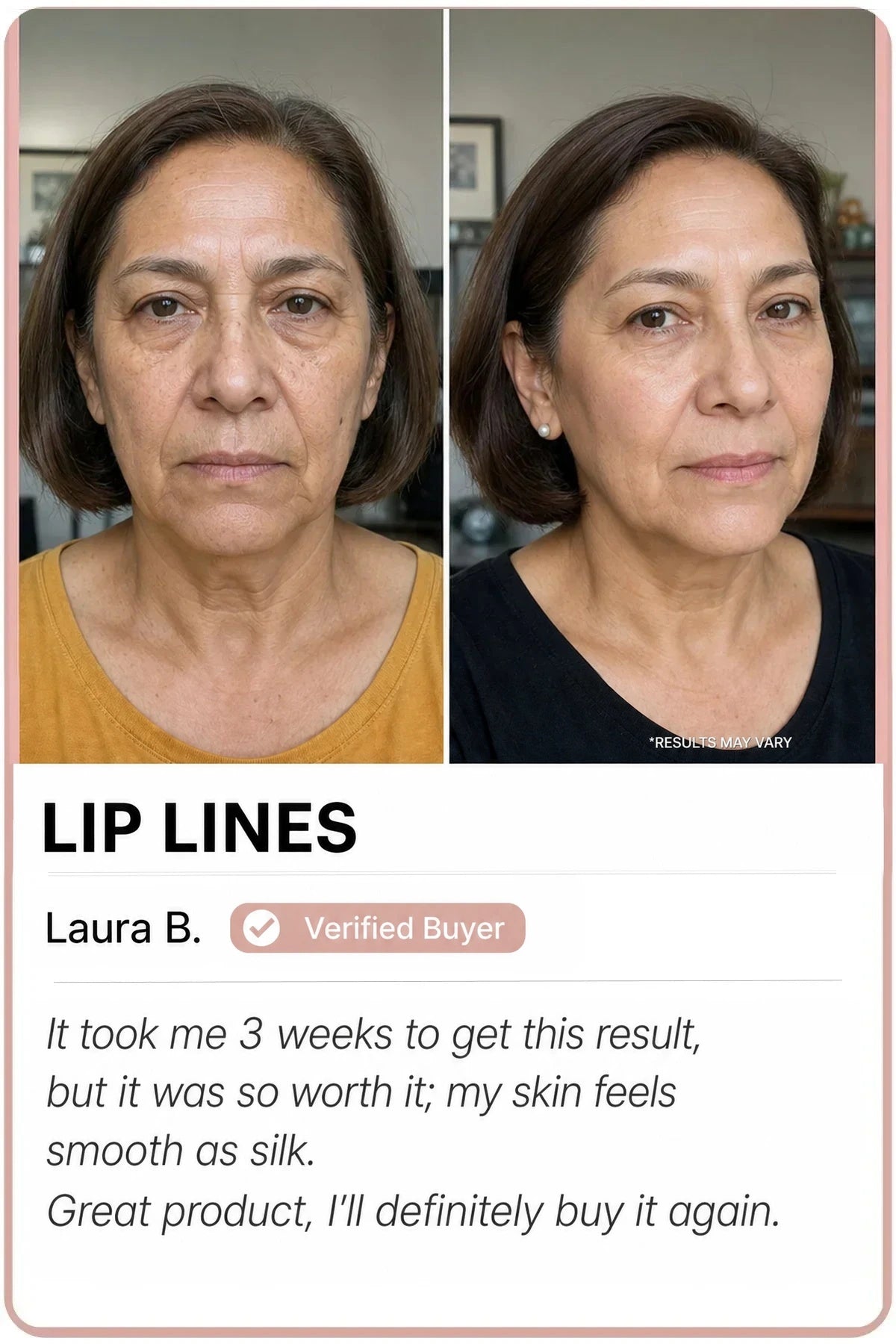 Sedanza before and after — Barcode lip lines, Laura B.