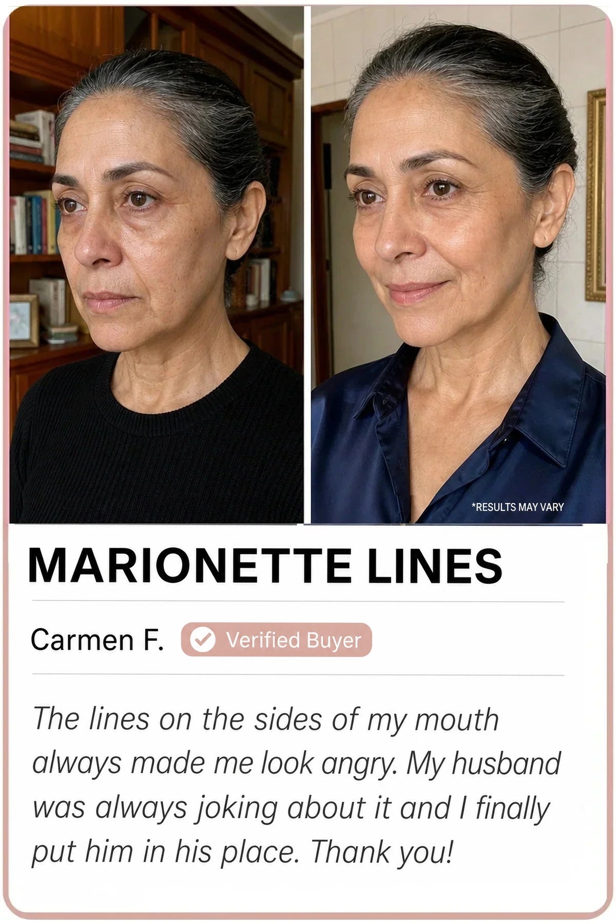 Sedanza before and after — Marionette lines, Carmen F.