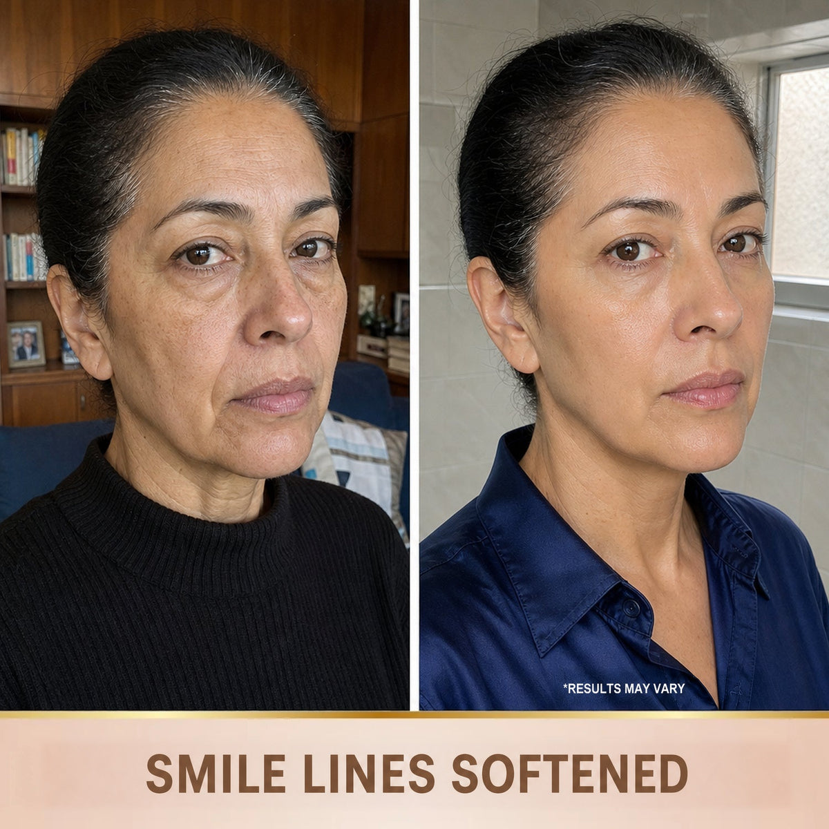Smile lines softened - before and after