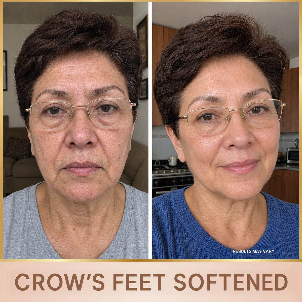 Crow's feet reduced - before and after